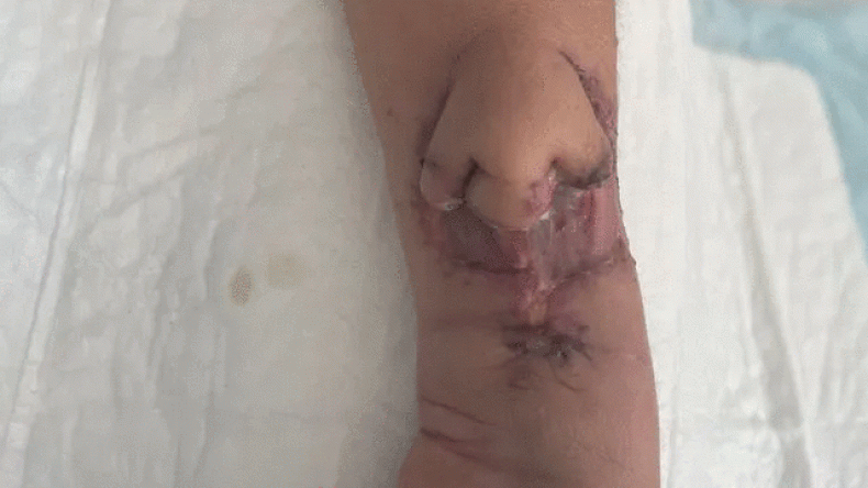 نجاح عملية زرع أنف في ذراع امرأة قبل نقله إلى وجهها