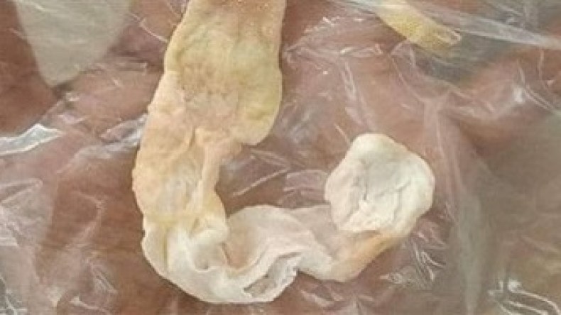 هذا ما نسيته طبيبة في أنف طفلة مصرية!