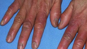 تورّم الأصابع.. حالة مرضية تظهر شتاء