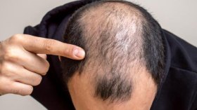 طبيبة من سطيف تصنع أوّل مستحضر يعالج تساقط الشعر