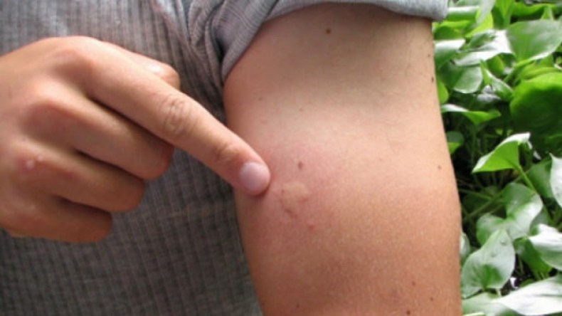 خبير في الفيروسات: 20 إصابة بالملاريا في الجزائر خلال أسبوعين