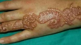 أطباء يحذرون من مضاعفات “حنة حرقوس” مجهولة المصدر