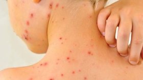 تحذيرات من عدوى “بوشوكة” وسط الأطفال والحوامل!