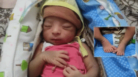 طفل يولد بـ 6 أصابع في كل يد وقدم والأطباء يعتبرون حالته نادرة