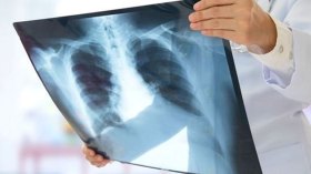 اطمئنوا.. السل ليس بالخطورة المصورة ولا حالات في الجزائر وسط المهاجرين