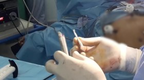 قص المعدة “موضة” الباحثين عن الرشاقة رغم المخاطر