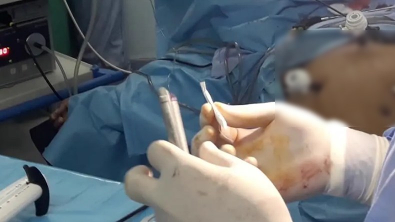 قص المعدة “موضة” الباحثين عن الرشاقة رغم المخاطر