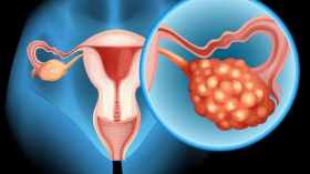 دراسة تكشف: نساء أكثر عرضة من غيرهن للإصابة بسرطان المبيض!