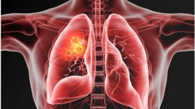 Cancer du poumon : les résultats positifs d’un vaccin thérapeutique
