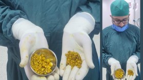 استخراج 300 حصاة من مرارة سيدة بسكيكدة