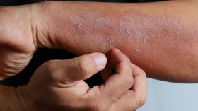 التهاب الجلد التأتبي .. مرض مزمن يقلب حياة المرضى