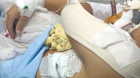 مستشفى مصطفى باشا: إنقاذ شاب اخترقت قطعة حديدية صدره (صور)