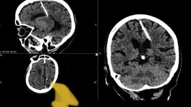بقي عالقا منذ ثمانين عاما.. اكتشاف صادم في دماغ عجوز روسية!