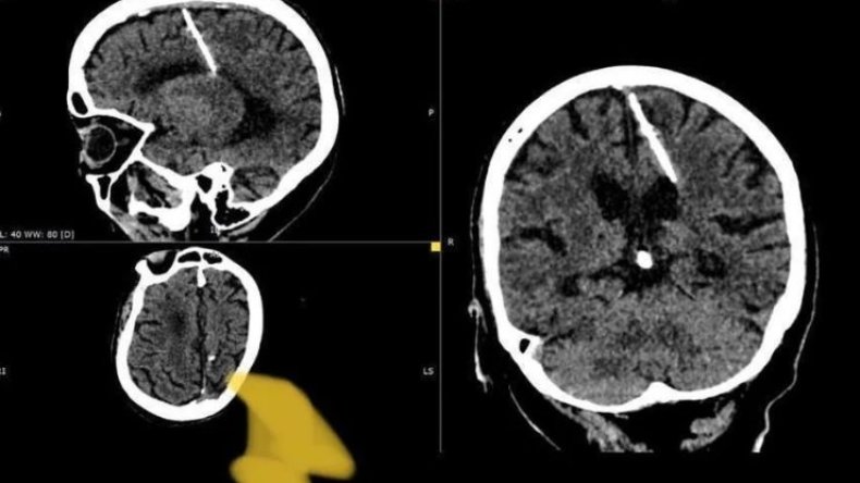 بقي عالقا منذ ثمانين عاما.. اكتشاف صادم في دماغ عجوز روسية!