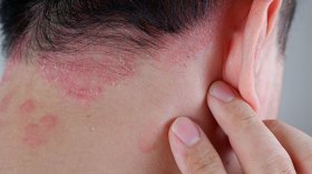 مرضى الصدفية يطالبون بإنشاء مراكز متخصصة ومرجعية للعلاج