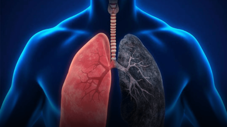 10 أعراض تشير إلى وجود مشاكل في الرئة