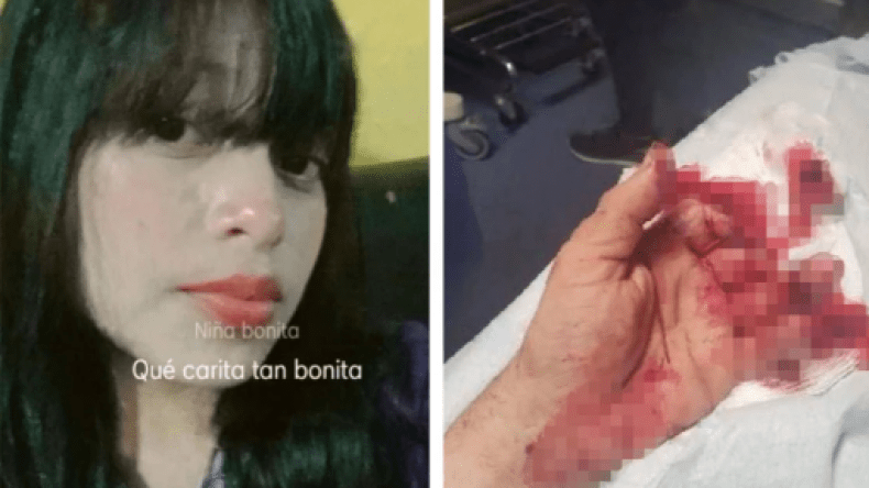 صور صادمة.. شابة تقطع أصابع أخيها بمنشار كهربائي بسبب سرقته طعامها!