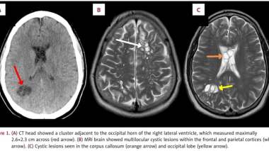 Voici ce qu’il advient à son cerveau en consommant du porc!