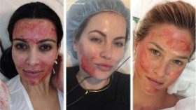 إصابة نساء بالإيدز بعد خضوعهن لتقنية “مصاص الدماء” التجميلية!