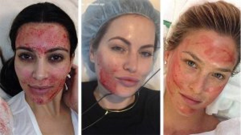 إصابة نساء بالإيدز بعد خضوعهن لتقنية “مصاص الدماء” التجميلية!