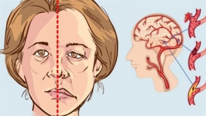 السكتات الدماغية.. خبراء يحذّرون النساء من خطرها ويقدمون 5 نصائح لهن
