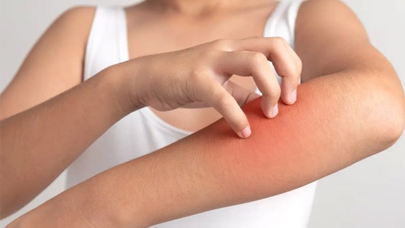 70 بالمائة من مرضى الحساسيّة في الجزائر أطفال