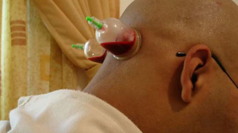 الرقية والحجامة.. ملاذ المقبلين على “الباك” لطرد قلق الامتحان