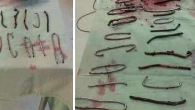 إخراج 20 مسمارا وأسلاكا معدنية من بطن رجل بسكيكدة