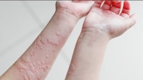 9 ردود فعل تحسسية قد تواجهها في البحر