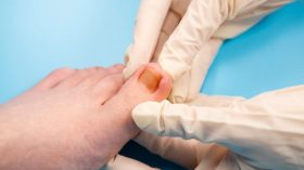 ظفر القدم الغارز في اللحم.. أسبابه وعوامل الخطورة