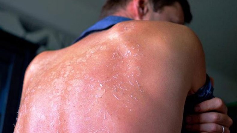 جمعية “آسيبا” تحذر من سرطان الجلد صيفا