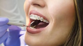 تقويم الأسنان.. معالجة لتشوهات الفكين وجمالية المظهر والابتسامة