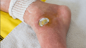 تعرّف على المراحل المبكرة للقدم السكرية