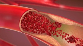 هذه هي علامات انسداد الشرايين وطرق تنظيفها طبيعيا!
