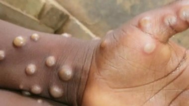 L’OMS appelle tous les pays à lutter ensemble contre le Mpox