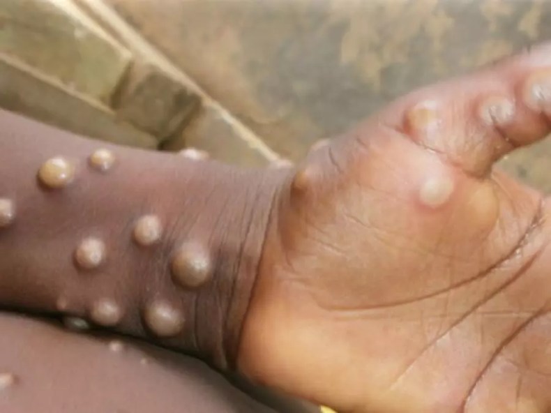 L’OMS appelle tous les pays à lutter ensemble contre le Mpox