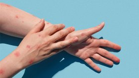 تسجيل أول إصابة بجدري القردة في هذا البلد المغاربي