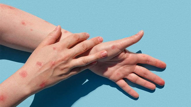 تسجيل أول إصابة بجدري القردة في هذا البلد المغاربي