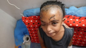 كسر الاحتلال جمجمتها وشوه ملامحها.. الطفلة “سيلا” تنتظر العلاج