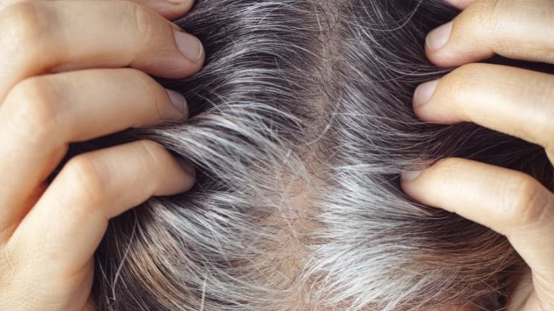 تعرّف على 11 عاملا يسبّب الشيب المبكر