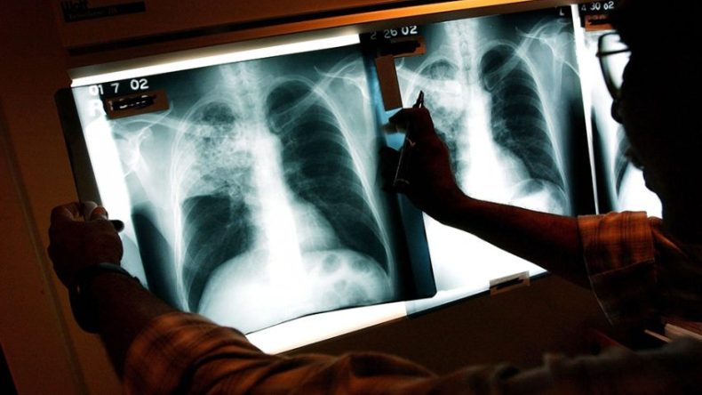 انخفاض معدل الإصابة بالسلّ الرئوي في الجزائر إلى أقل من 10 حالات لكل 100 ألف نسمة