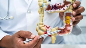 ارتفاع مقلق للإصابة بسرطان المستقيم والقولون