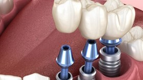 تقنية زراعة الأسنان تدخل المستشفيات العمومية