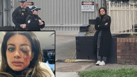 محامية أسترالية معرضة لفقدان البصر بسبب دعهما لغزة