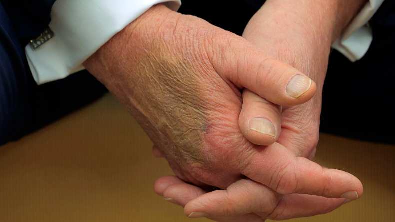 كدمات على يد ترامب تثير الجدل… والبيت الأبيض يوضح