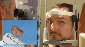 سن يتحول إلى عين.. إنجاز طبي غير مسبوق في كندا !