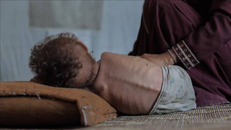 Gaza : 148 Palestiniens morts de malnutrition en raison du blocus israélien de l’aide, selon l’OMS