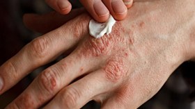 الإكزيما.. جزائريون بين الألم الجلدي والوجع النفسي