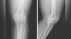 خيوط من الذهب الخالص في ركبتي امرأة.. ما القصة؟!