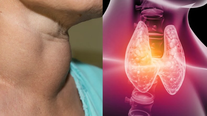 ارتفاع إصابة الجزائريين بداء “الهاشيموتو” وأمراض الغدة الدرقية!